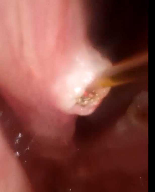 ENT Laser Procedures
