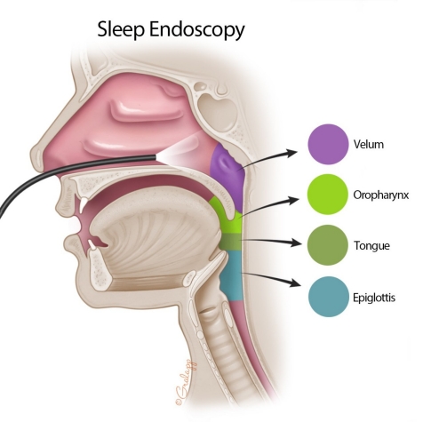 DISE test for Snoring & Sleep Apnea