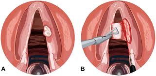 Early detection and conservative laser treatment of vocal cords cancer