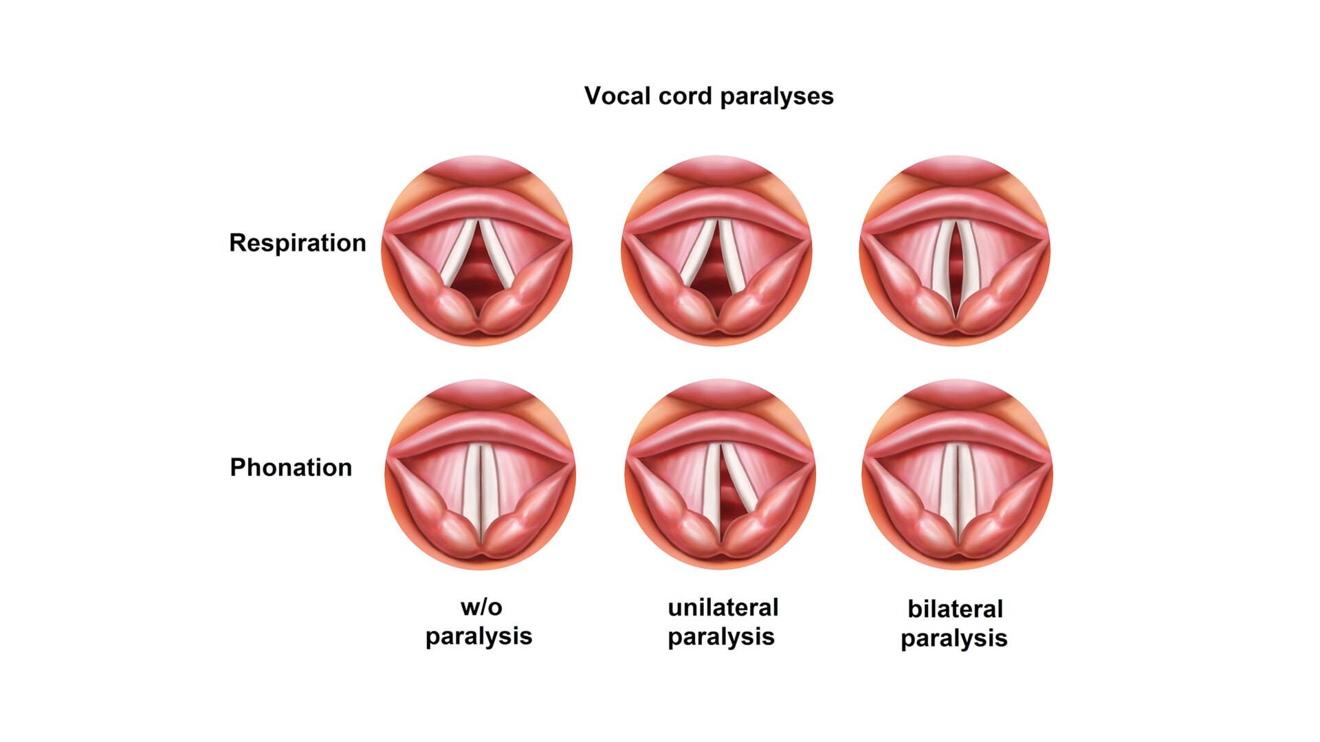 Management of unilateral and bilateral vocal cord paralysis