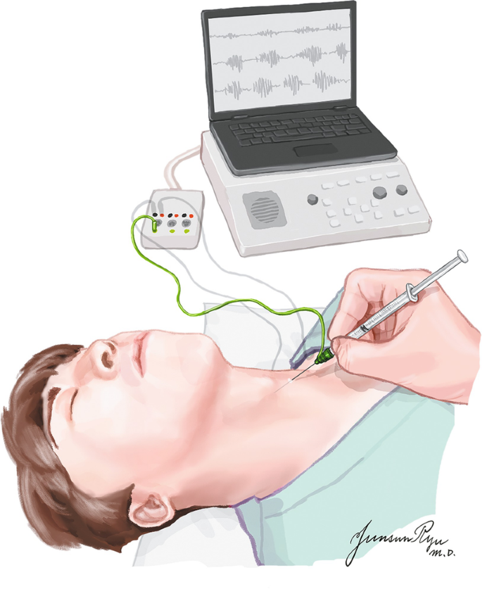 Electromyography of Laryngeal muscles (L-EMG)