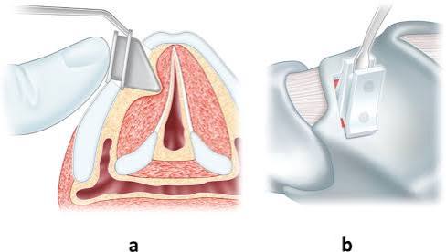 Thyroplasty and larynx framework surgery (laryngoplasty)